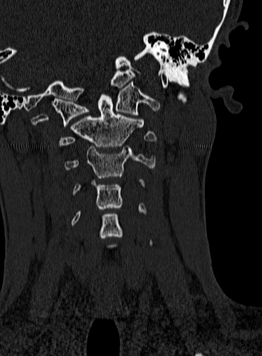 Atlantoaxial subluxation (Radiopaedia 44681-48450 Coronal bone window 34).jpg