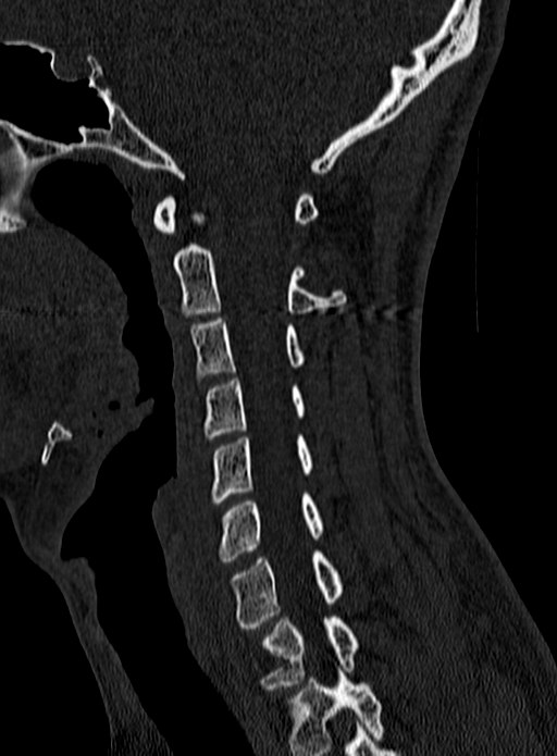 Atlantoaxial subluxation (Radiopaedia 44681-48450 Sagittal bone window 56).jpg