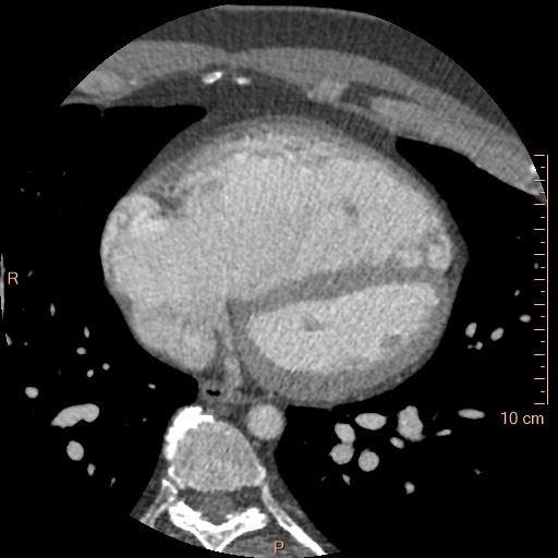 Atrial septal defect (upper sinus venosus type) with partial anomalous pulmonary venous return into superior vena cava (Radiopaedia 73228-83961 A 182).jpg