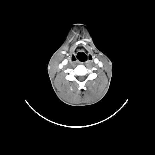 File:Atypical 2nd branchial cleft cyst (type IV) - infected (Radiopaedia 20986-20924 A 17).jpg