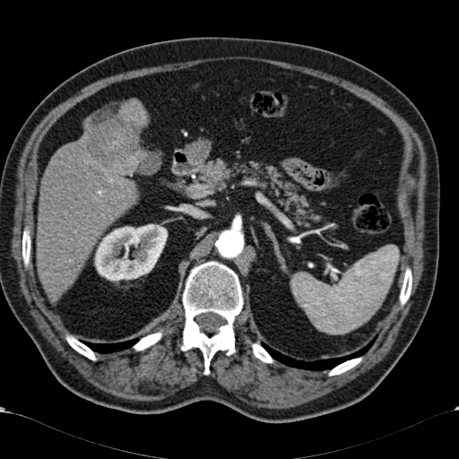 Atypical hepatocellular carcinoma (Radiopaedia 41744-44698 A 35).jpg