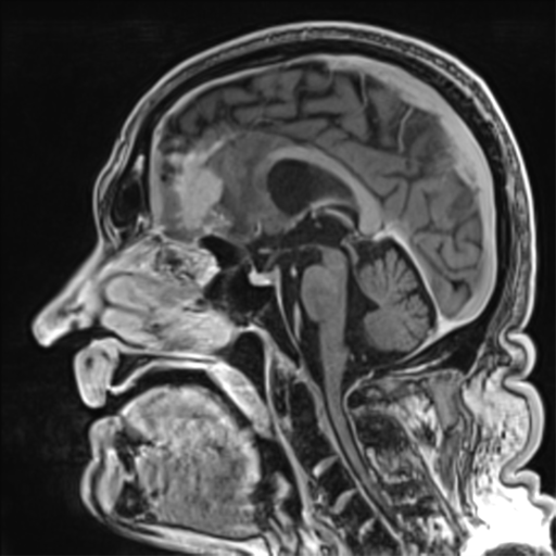 Atypical meningioma (WHO grade II) with brain invasion (Radiopaedia 57767-64729 Axial T1 C+ 51).png