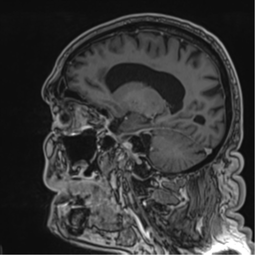 Atypical meningioma (WHO grade II) with brain invasion (Radiopaedia 57767-64729 Sagittal T1 C+ 29).png