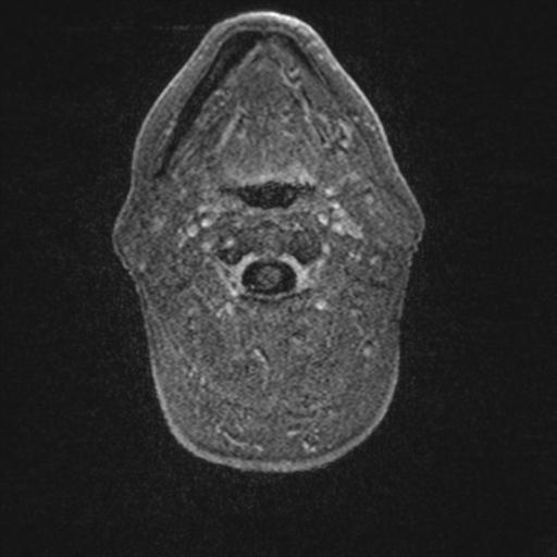 Atypical meningioma (grade II) - en plaque (Radiopaedia 29633-30147 Axial T1 C+ 4).jpg