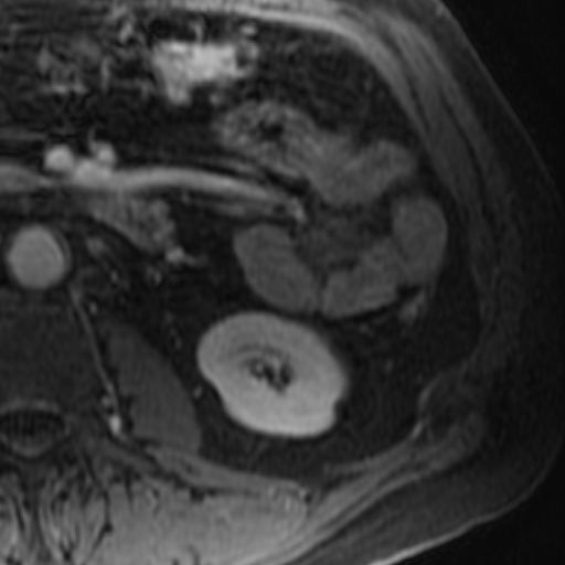 File:Atypical renal cyst on MRI (Radiopaedia 17349-17046 D 25).jpg