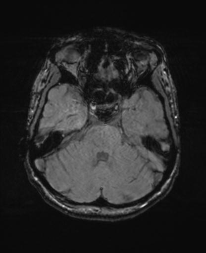 Autoimmune limbic encephalitis (Radiopaedia 30363-31005 SWI - magnitude 23).jpg