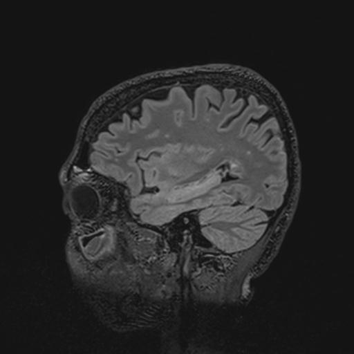 Autoimmune limbic encephalitis (Radiopaedia 30363-31005 Sagittal FLAIR 111).jpg