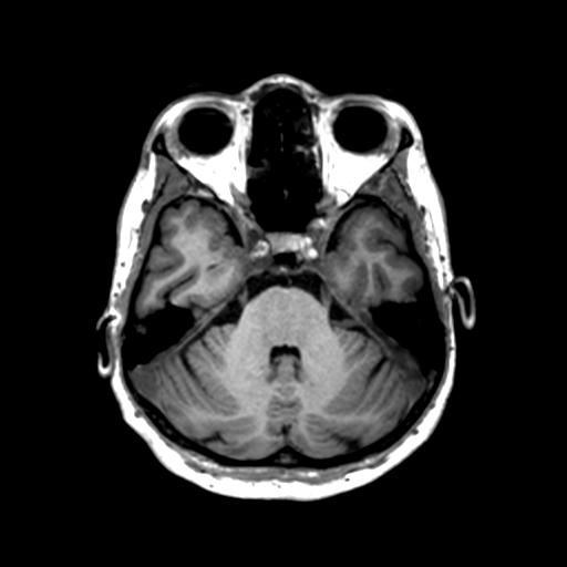 Autoimmune limbic encephalitis (Radiopaedia 30363-31005 T1 Axial 1mm 48).jpg
