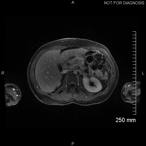 Autoimmune pancreatitis (Radiopaedia 88443-105101 A 62).jpg