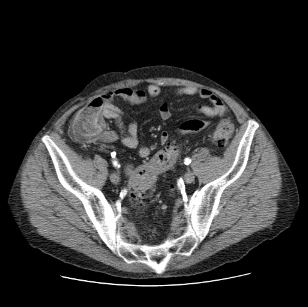 Autosomal dominant polycystic kidney disease (Radiopaedia 27851-28094 B 102).jpg