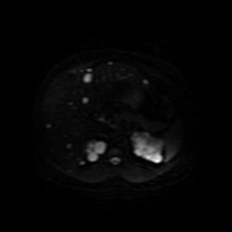 Autosomal dominant polycystic kidney disease (Radiopaedia 50259-55611 Axial DWI 15).jpg
