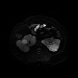 Autosomal dominant polycystic kidney disease (Radiopaedia 50259-55611 Axial DWI 27).jpg