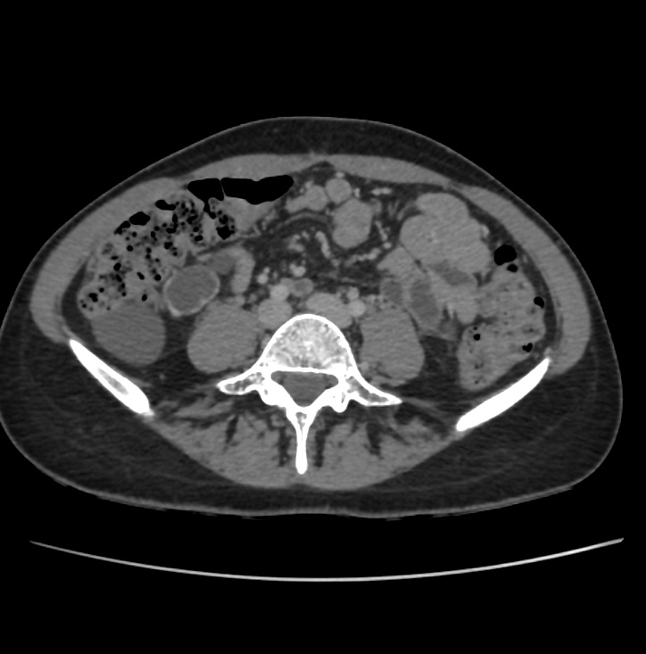 Autosomal dominant polycystic kidney disease - early onset (Radiopaedia 40734-43387 A 55).jpg