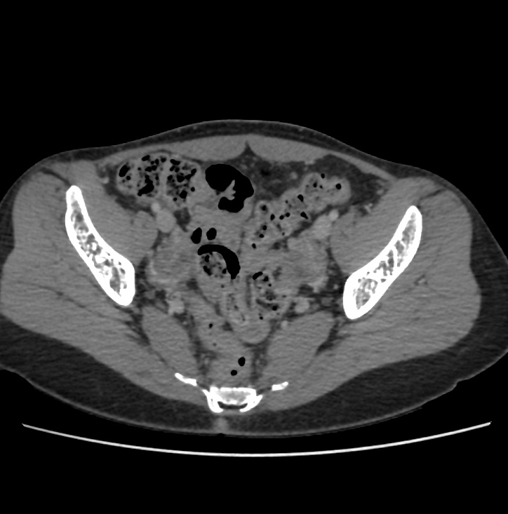 Autosomal dominant polycystic kidney disease - early onset (Radiopaedia 40734-43387 A 71).jpg