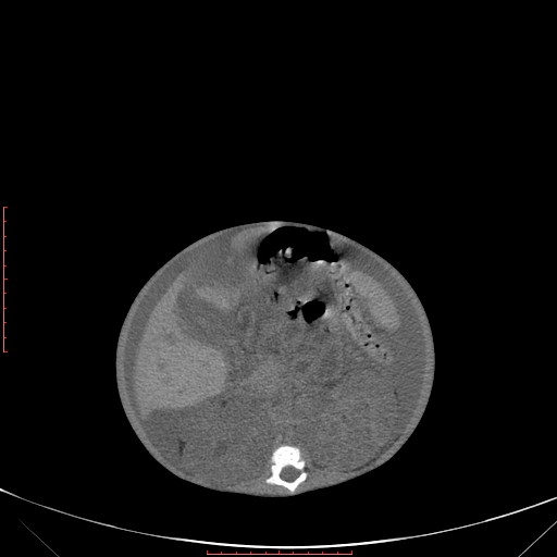File:Autosomal recessive polycystic kidney disease associated with Caroli disease (Radiopaedia 61932-69984 Axial non-contrast 197).jpg