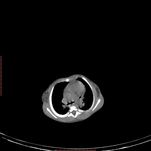 Autosomal recessive polycystic kidney disease associated with Caroli disease (Radiopaedia 61932-69984 Axial non-contrast 44).jpg