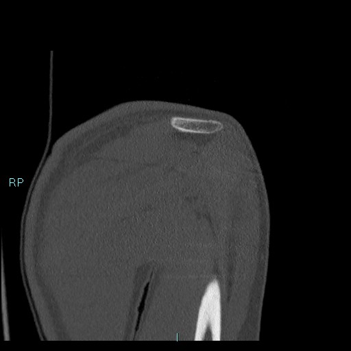 Avascular necrosis after fracture dislocations of the proximal humerus (Radiopaedia 88078-104655 Coronal bone window 51).jpg