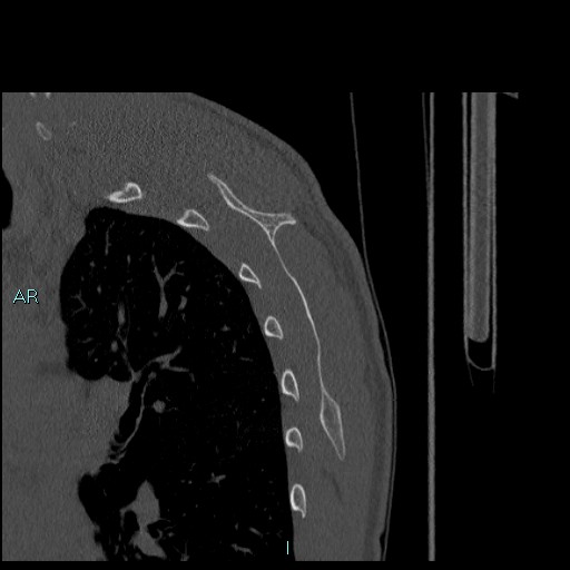 Avascular necrosis after fracture dislocations of the proximal humerus (Radiopaedia 88078-104655 Sagittal bone window 72).jpg