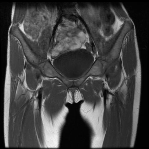 File:Avascular necrosis of the hip (Radiopaedia 29563-30067 Coronal T1 3).jpg