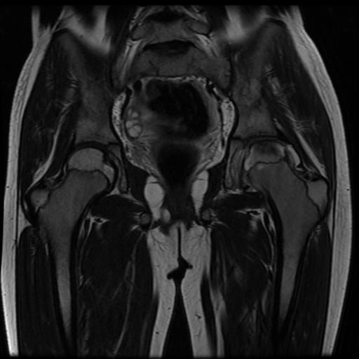 File:Avascular necrosis of the hip (Radiopaedia 29563-30067 Coronal T2 9).jpg