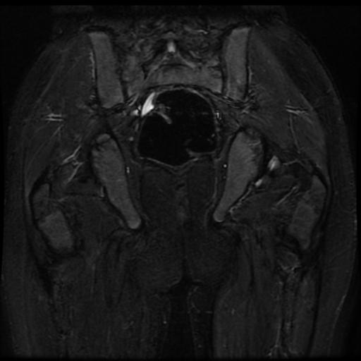 File:Avascular necrosis of the hip (Radiopaedia 29563-30067 Coronal T2 fat sat 13).jpg