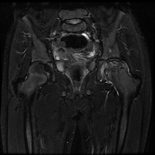 File:Avascular necrosis of the hip (Radiopaedia 29563-30067 Coronal T2 fat sat 8).jpg