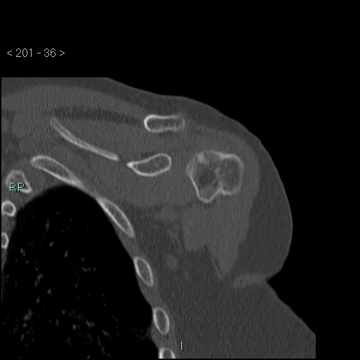 Avascular necrosis of the shoulder - Cruess stage I (Radiopaedia 77674-89887 Coronal bone window 35).jpg
