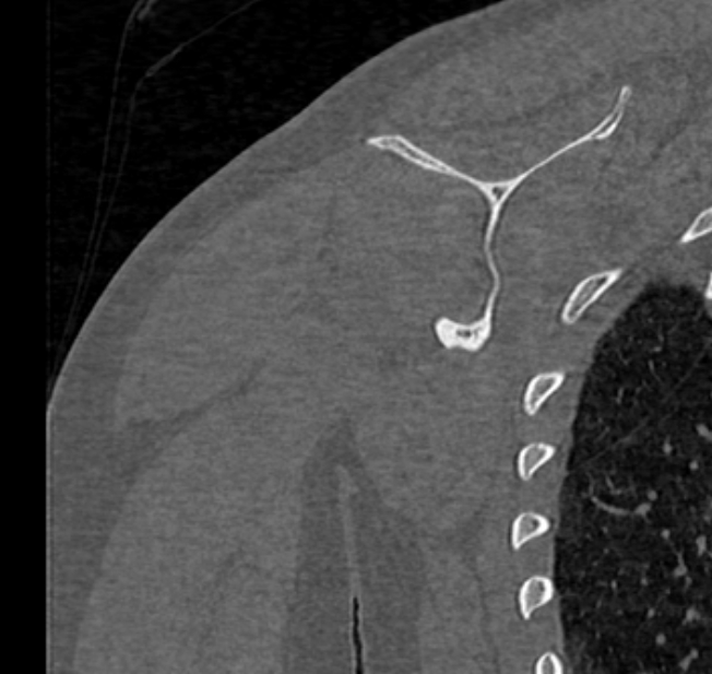 Avulsion fracture - greater tuberosity of humerus (Radiopaedia 71216-81514 Coronal bone window 58).jpg