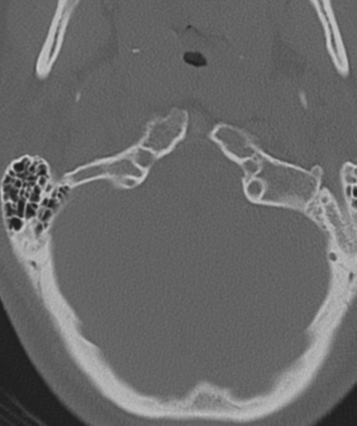 Axis peg fracture (type 3) and atlas lateral mass (type 4) fracture (Radiopaedia 37474-39324 Axial bone window 8).png
