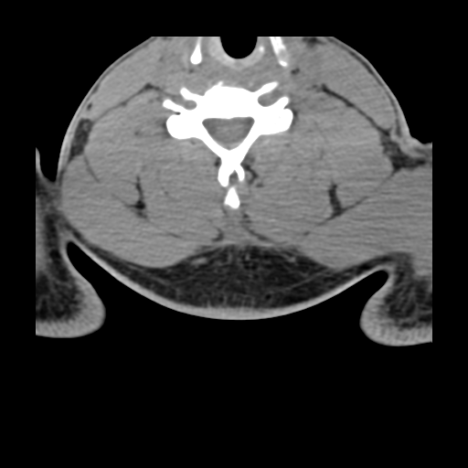 File:Axis peg fracture (type 3) and atlas lateral mass (type 4) fracture (Radiopaedia 37474-39324 D 1).png