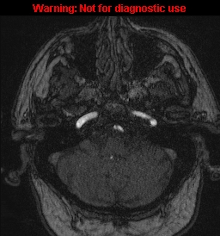 Azygos anterior cerebral artery (Radiopaedia 59325-66677 Axial MRA 25).jpg