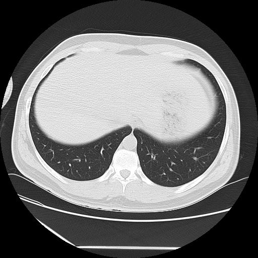 Azygos fissure (Radiopaedia 88181-104784 Axial lung window 45).jpg