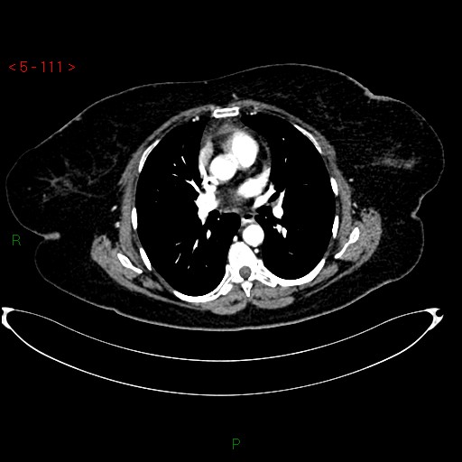 Azygos fissure and lobe (Radiopaedia 47620-52278 A 97).jpg