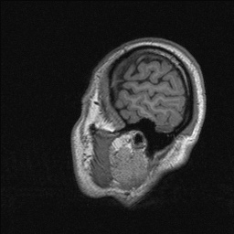 Balo concentric sclerosis (Radiopaedia 50458-55940 Sagittal T1 137).jpg