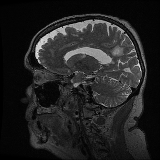 Balo concentric sclerosis (Radiopaedia 53875-59982 Sagittal 3D FSE 111).jpg