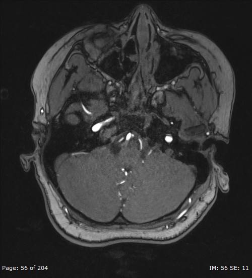 Balo concentric sclerosis (Radiopaedia 61637-69636 Axial MRA 56).jpg