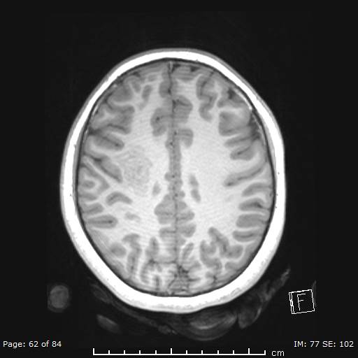 File:Balo concentric sclerosis (Radiopaedia 61637-69636 Axial T1 62).jpg