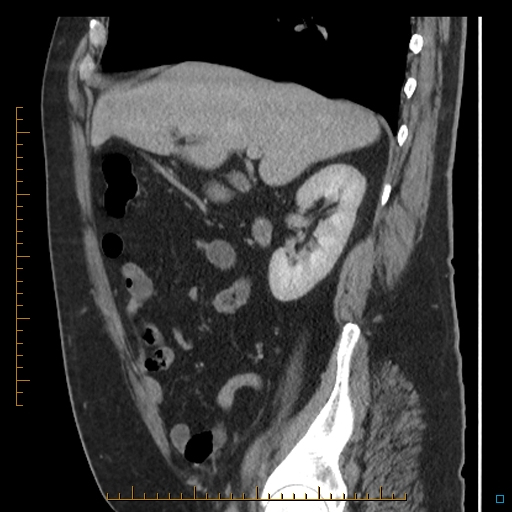 Bariatric balloon causing gastric outlet obstruction (Radiopaedia 54449-60672 C 56).jpg