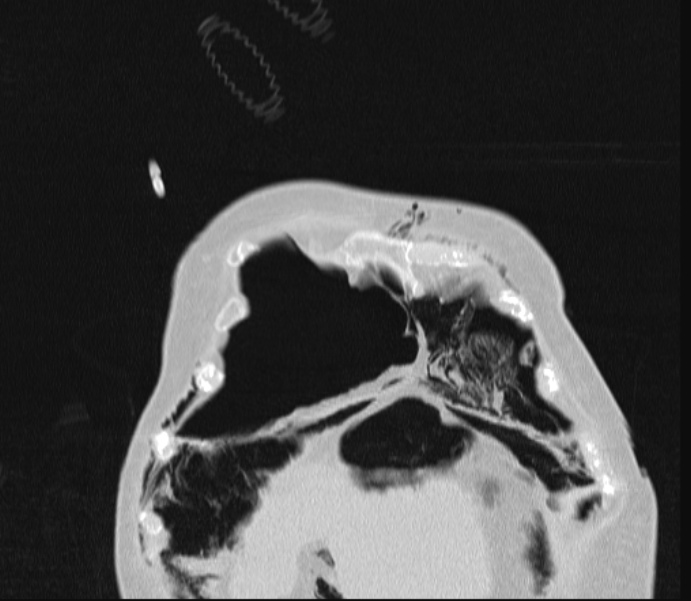 Barotrauma due to mechanical ventilation (Radiopaedia 28079-28336 Coronal lung window 14).jpg