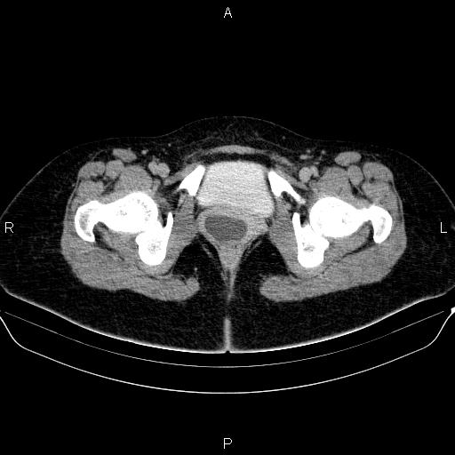 Bartholin gland cyst (Radiopaedia 62635-70930 C 75).jpg