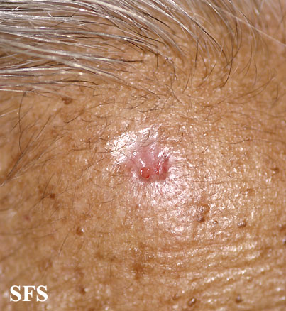Basal Cell Carcinoma (Dermatology Atlas 141).jpg