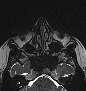 File:Basal cell carcinoma - nasal region (Radiopaedia 70292-80365 Axial Gradient Echo 47).jpg
