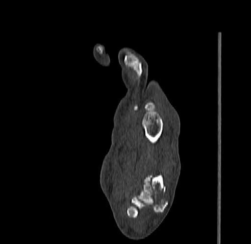 Base of 2nd metacarpal fracture (Radiopaedia 73741-84544 Sagittal bone window 56).jpg