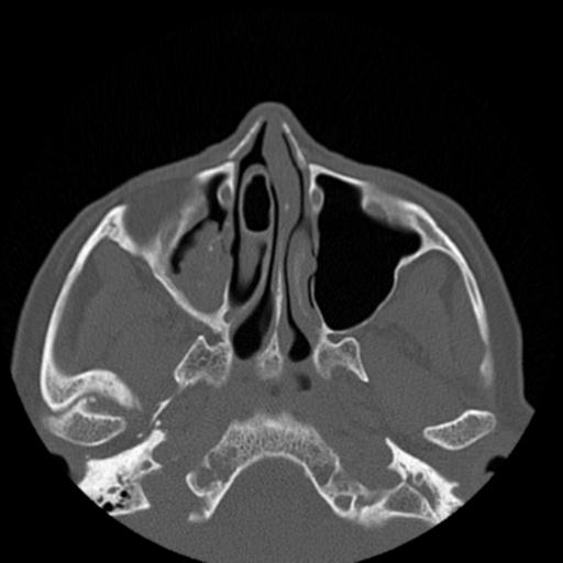 File:Base of skull chondrosarcoma (Radiopaedia 30410-31071 Axial bone window 17).jpg