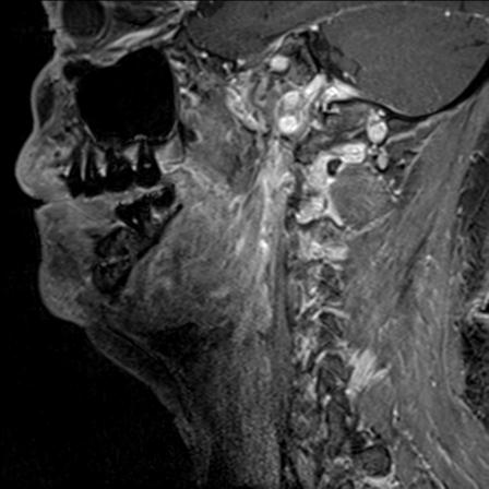 File:Base of tongue squamous cell carcinoma (Radiopaedia 31174-31884 F 119).jpg