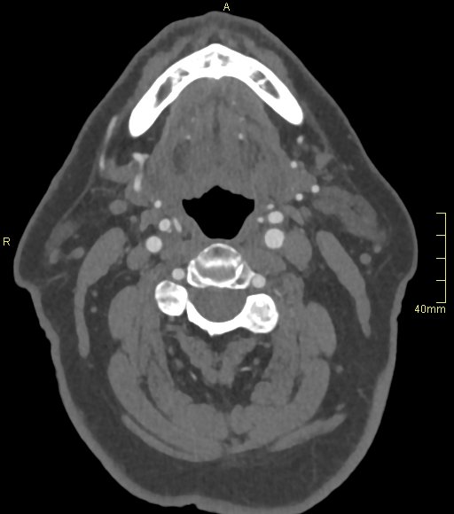 Basilar artery aneurysm (Radiopaedia 56261-62932 A 6).jpg