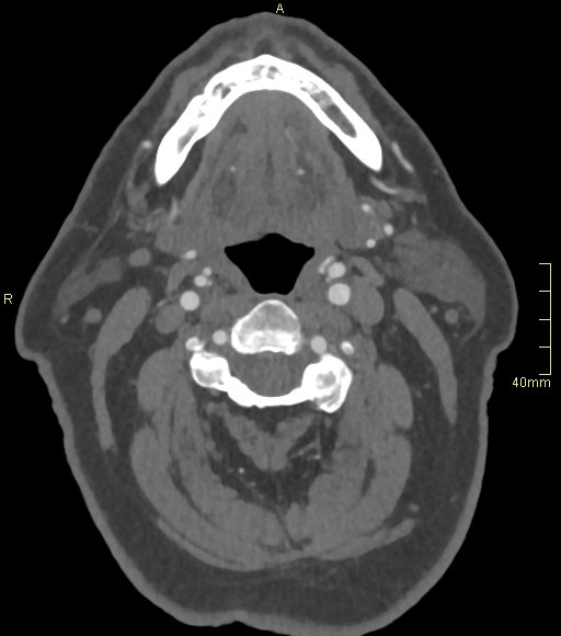 Basilar artery aneurysm (Radiopaedia 56261-62932 A 8).jpg