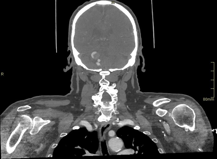 Basilar artery aneurysm (Radiopaedia 56261-62932 B 44).jpg