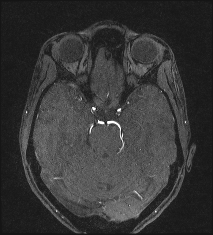 Basilar artery perforator aneurysm (Radiopaedia 82455-97733 Axial MRA 94).jpg