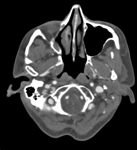 Basilar tip aneurysm with coiling (Radiopaedia 53912-60086 A 19).jpg